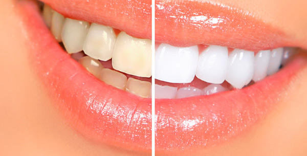 отбеливание зубов дома - фото до и после