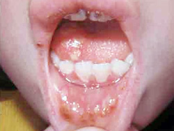 фото герпетического стоматита у ребенка