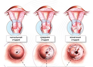 стадии развития рака шейки матки