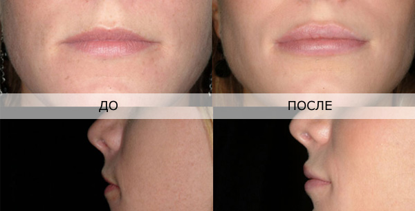 отзывы о увеличение губ гиалуроновой кислотой