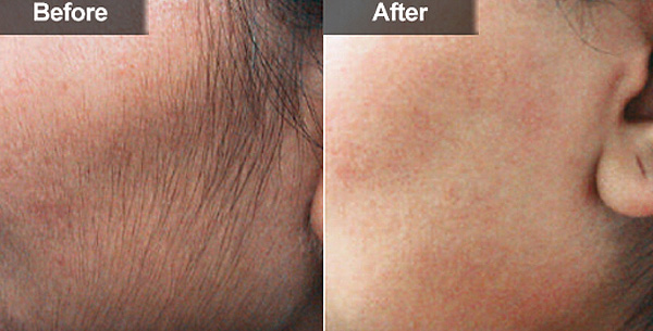 Удаление волос лазером - до и после