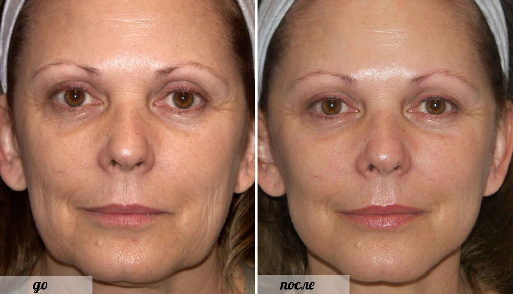 фото до и после биоармирования лица