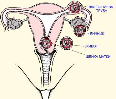 возможные возникновения внематочной беременности 
