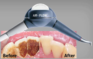 Система Air flow для чистки зубов
