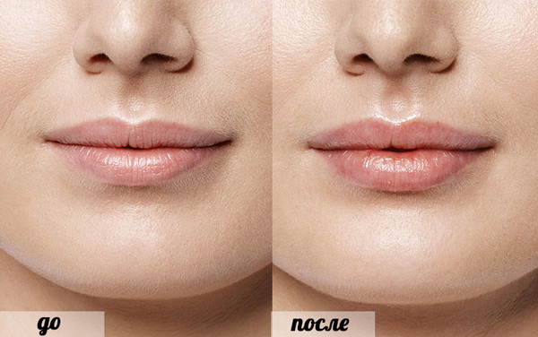 фото до и после контурной пластики губ