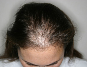 пример выпадения волос у женщин